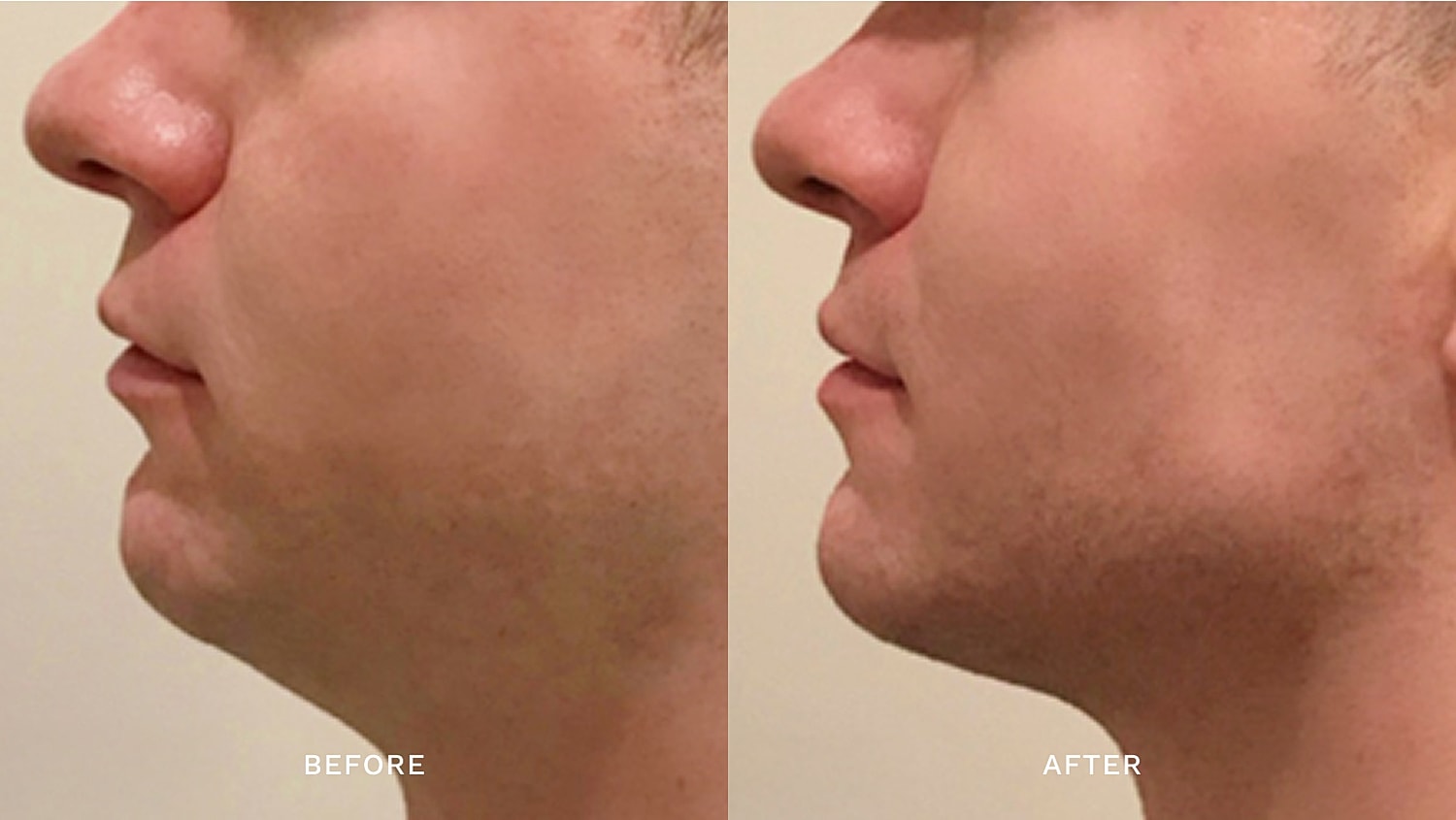 Before and after jawline enhancement comparison.