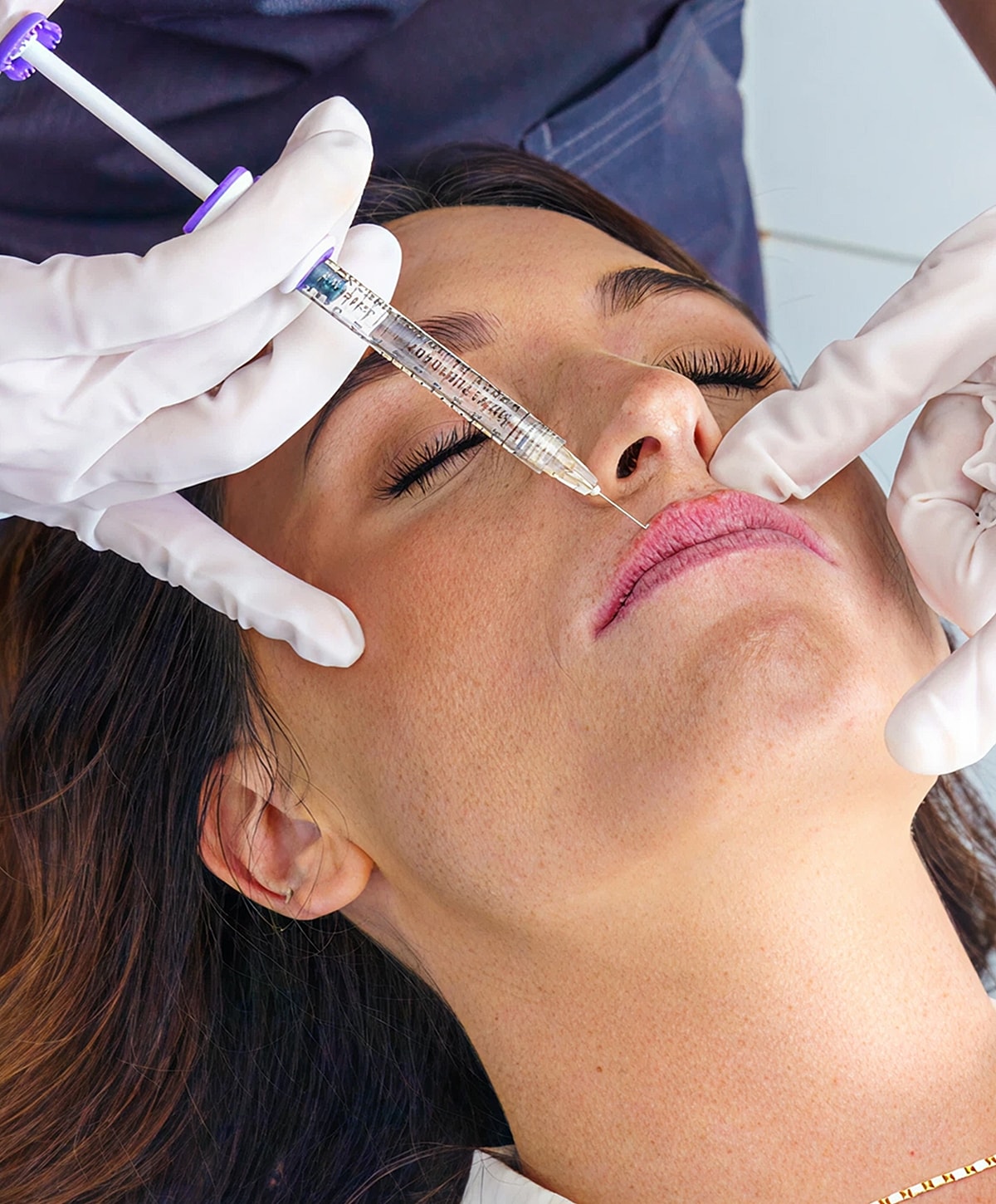 Injecting lip filler in a cosmetic procedure.
